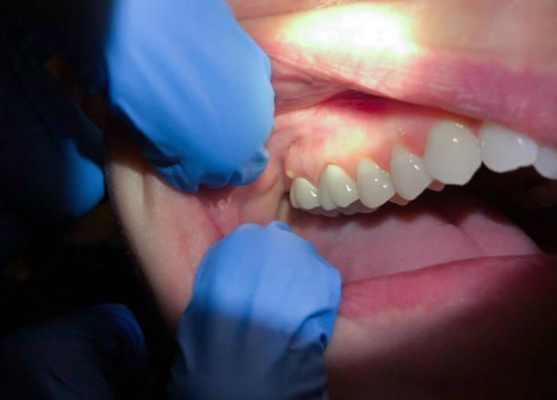 Best Emergency Dental Services for Seniors in Wichita Falls, TX